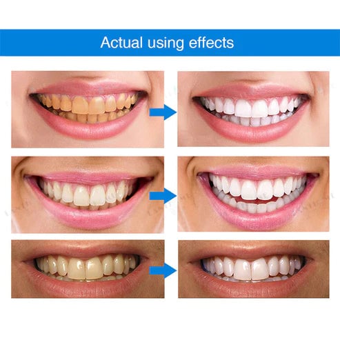 Teeth Whitening Essence