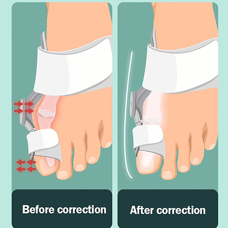 Hallux Valgus Orthosis Eighth Generation